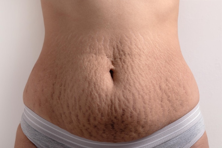 Achieve Smooth And Flawless Skin With Stretch Mark Microneedling
