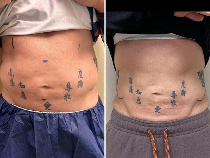 coolsculpting dc