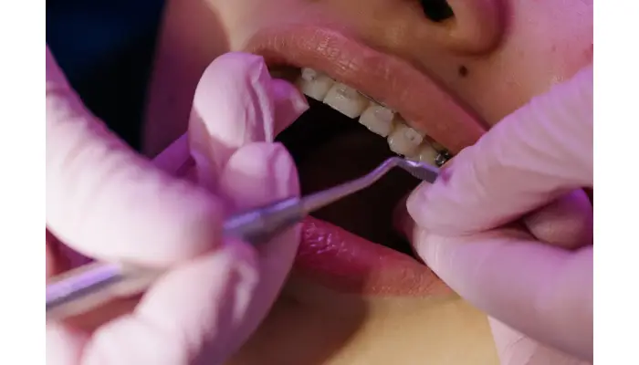 Understanding The Benefits Of Dental Fillings In Houston For Cavity Treatment