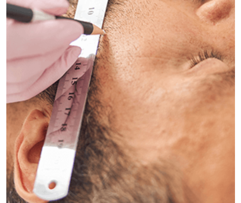 What Is FUE Hair Transplant In Istanbul? You Need To Know